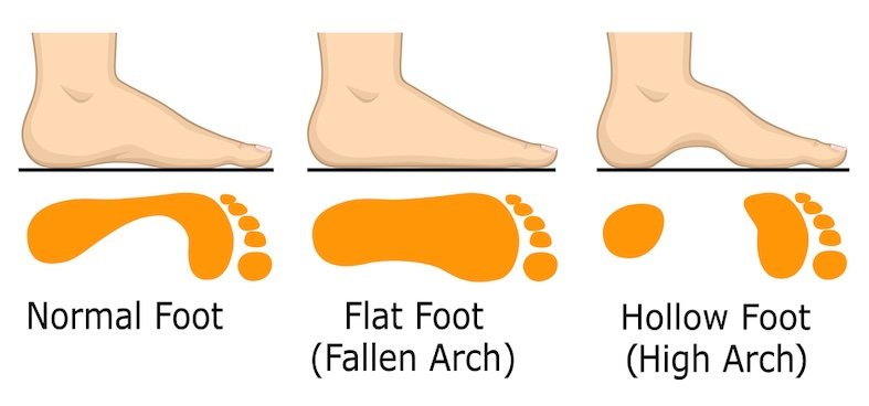 What type of arches do you have?